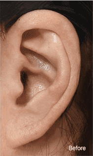 Skill matters in post-surgery scarring too. 1