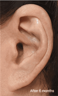 Skill matters in post-surgery scarring too. 3