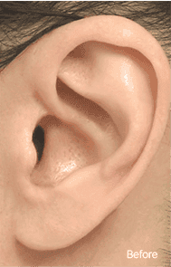 Skill matters in post-surgery scarring too. 1