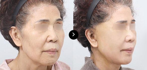 Full SMAS Face Lifting image 1