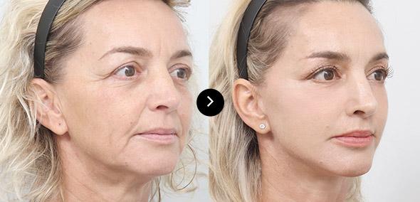 Full SMAS Face Lifting image 3