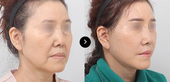 Full SMAS Face Lifting image 4