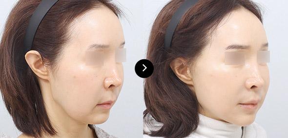 Full SMAS Face Lifting image 5