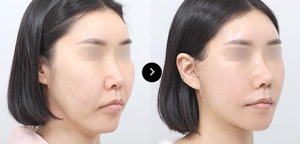 Semi-Face Lifting image 2