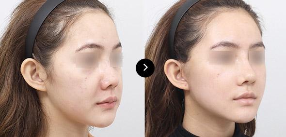 Semi-Face Lifting image 3