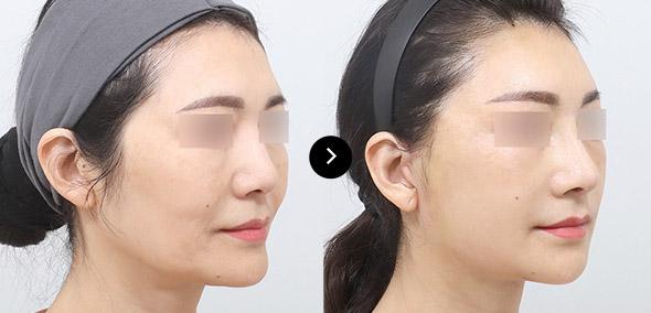 Semi-Face Lifting image 4