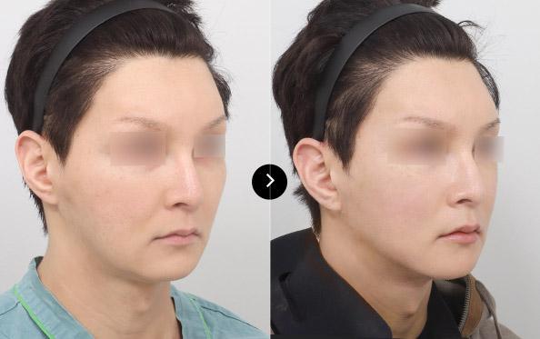 Mini Incision Face Lifting image 1