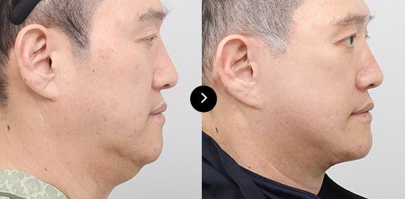 Neck Lifting image 1