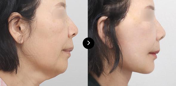 Neck Lifting image 2