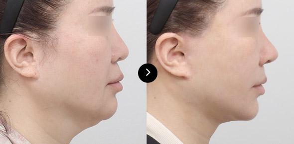 Neck Lifting image 3