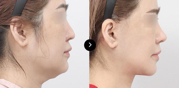 Neck Lifting image 4