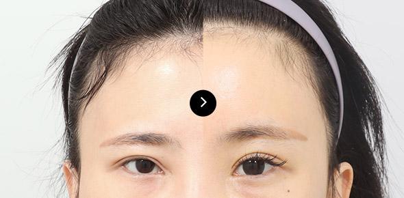 Endoscopic Forehead Lifting image 1
