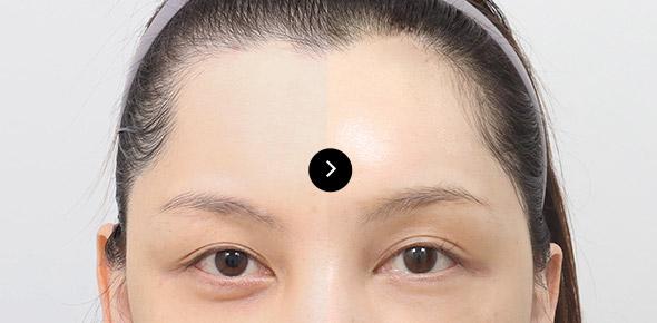 Endoscopic Forehead Lifting image 2