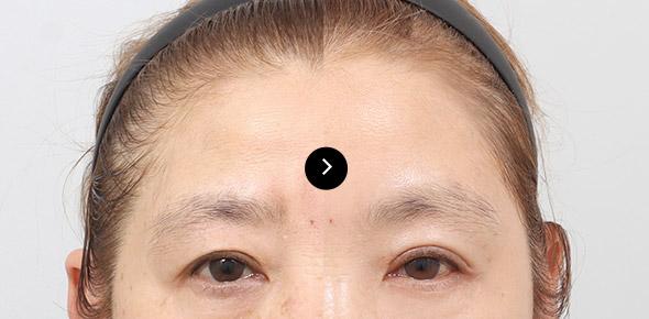 Endoscopic Forehead Lifting image 3