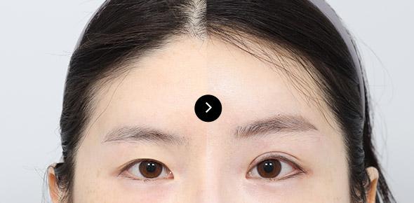 Endoscopic Forehead Lifting image 4