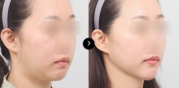 Double Chin Elasticum Thread Lifting image 1