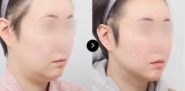 Double Chin Elasticum Thread Lifting image 2