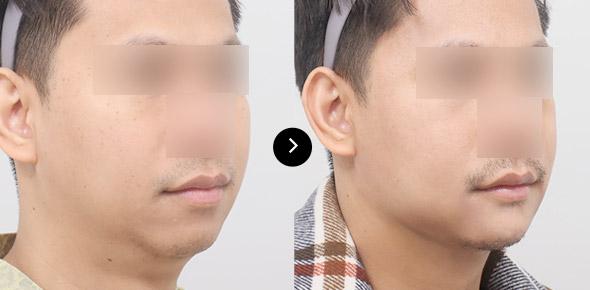 Double Chin Elasticum Thread Lifting image 3