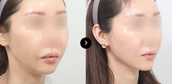 Double Chin Elasticum Thread Lifting image 4