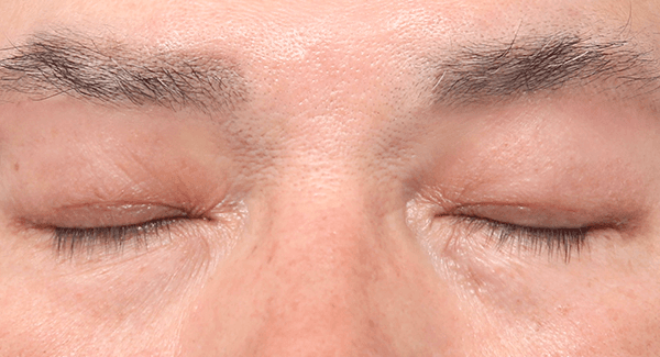 1 month after surgery