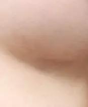 Inframammary Fold Area after 2 Months