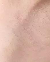 Inframammary Fold Area after 1 Month