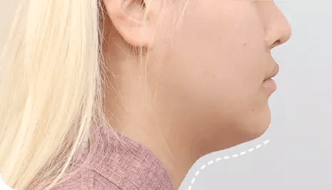 Submentoplasty before surgery