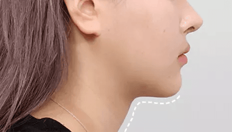 Submentoplasty 1 month after surgery