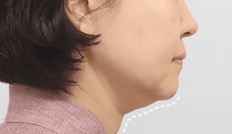 Submentoplasty before surgery