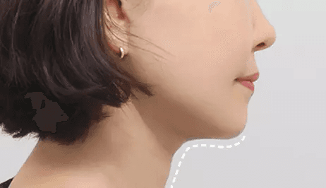 Submentoplasty 2 months after surgery