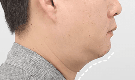 Submentoplasty before surgery