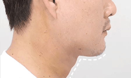 Submentoplasty 1 month after surgery