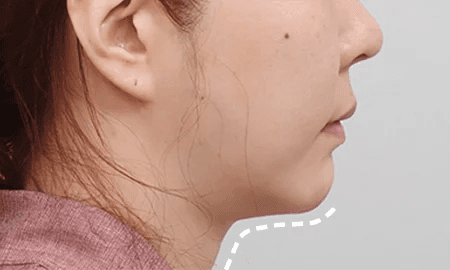 Submentoplasty before surgery