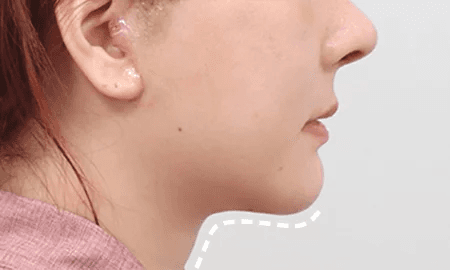 Submentoplasty 2 weeks after surgery