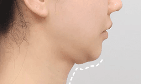 Submentoplasty with salivary gland removal before surgery