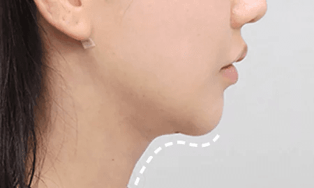 Submentoplasty with salivary gland removal 1 week after surgery