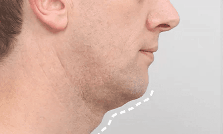 Submentoplasty with salivary gland removal before surgery