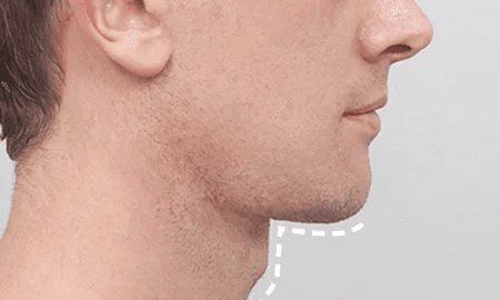 Submentoplasty with salivary gland removal 1 month after surgery