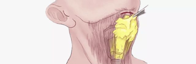 Fat removal from subcutaneous layer beneath platysma muscle