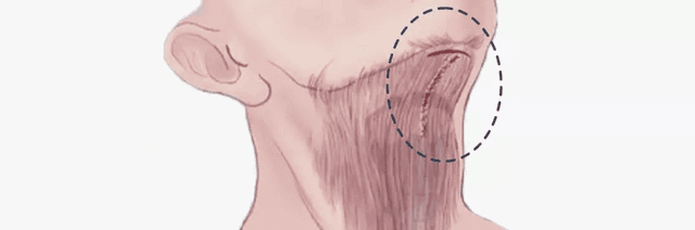 Platysma muscle tightening procedure