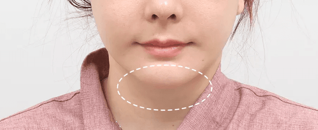 Submentoplasty scar from front view 2 weeks after surgery