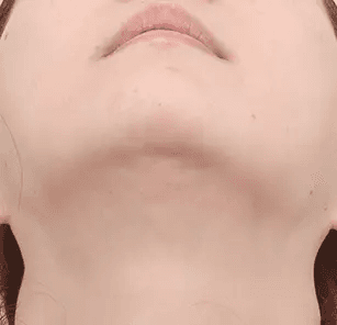 Incisional scar before treatment