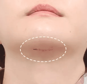 Incisional scar after 2 weeks