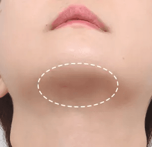 Incisional scar after 1 month