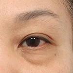 Upper Blepharoplasty Lifting
