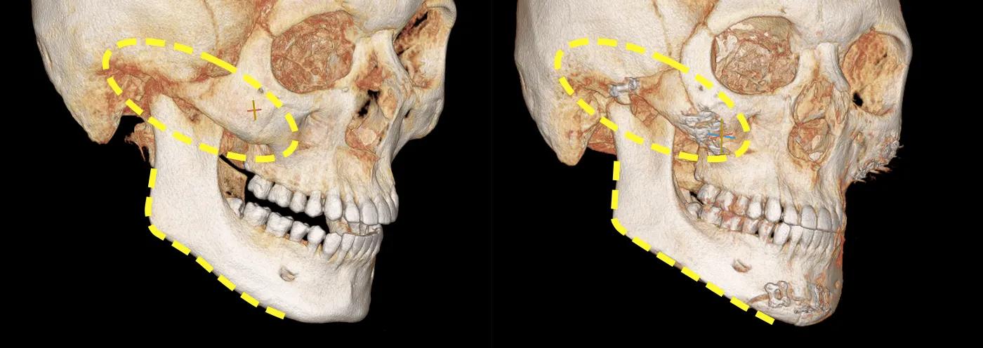 3D-CT before and after surgery photo 1