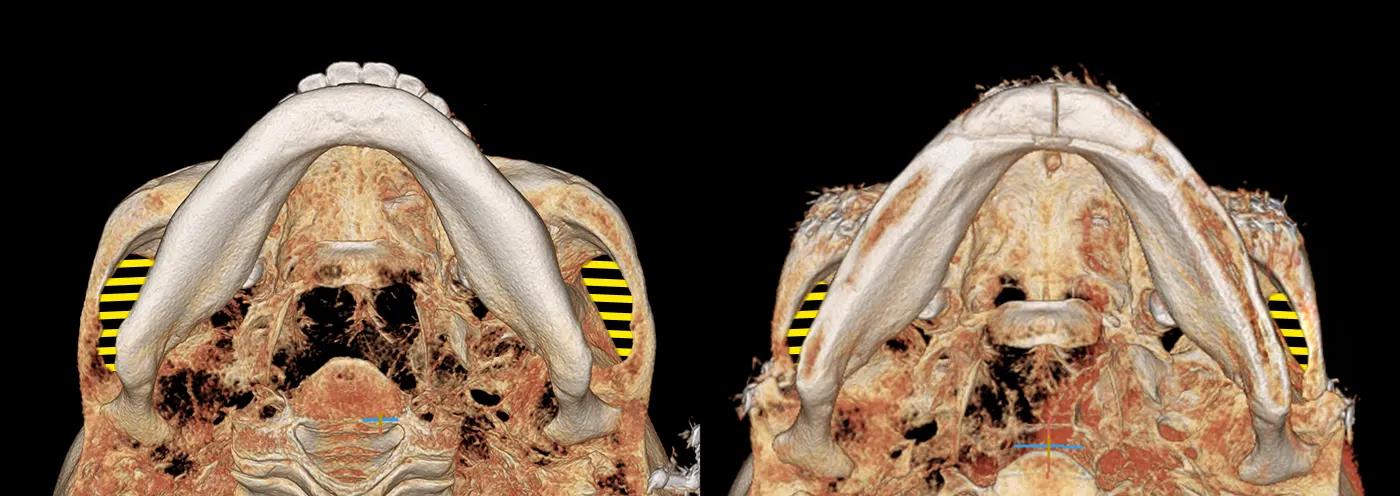 3D-CT before and after surgery photo 2