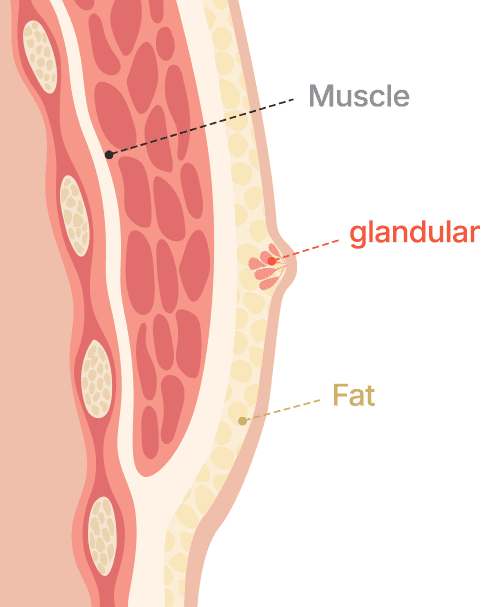 Gynecomastia surgery