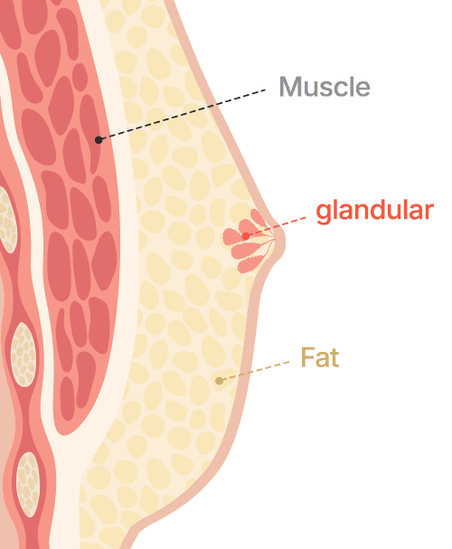 Gynecomastia surgery