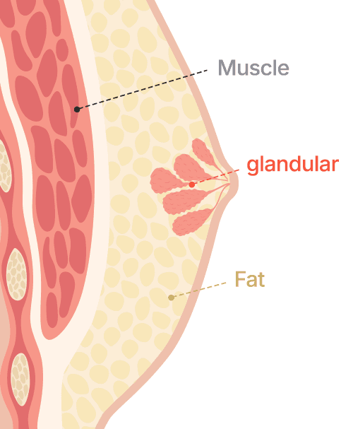 Gynecomastia surgery